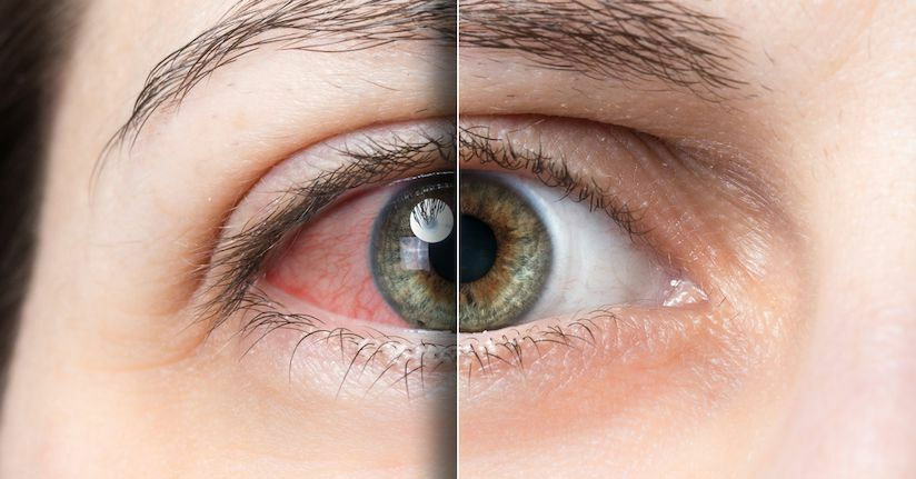 What causes a cataract?